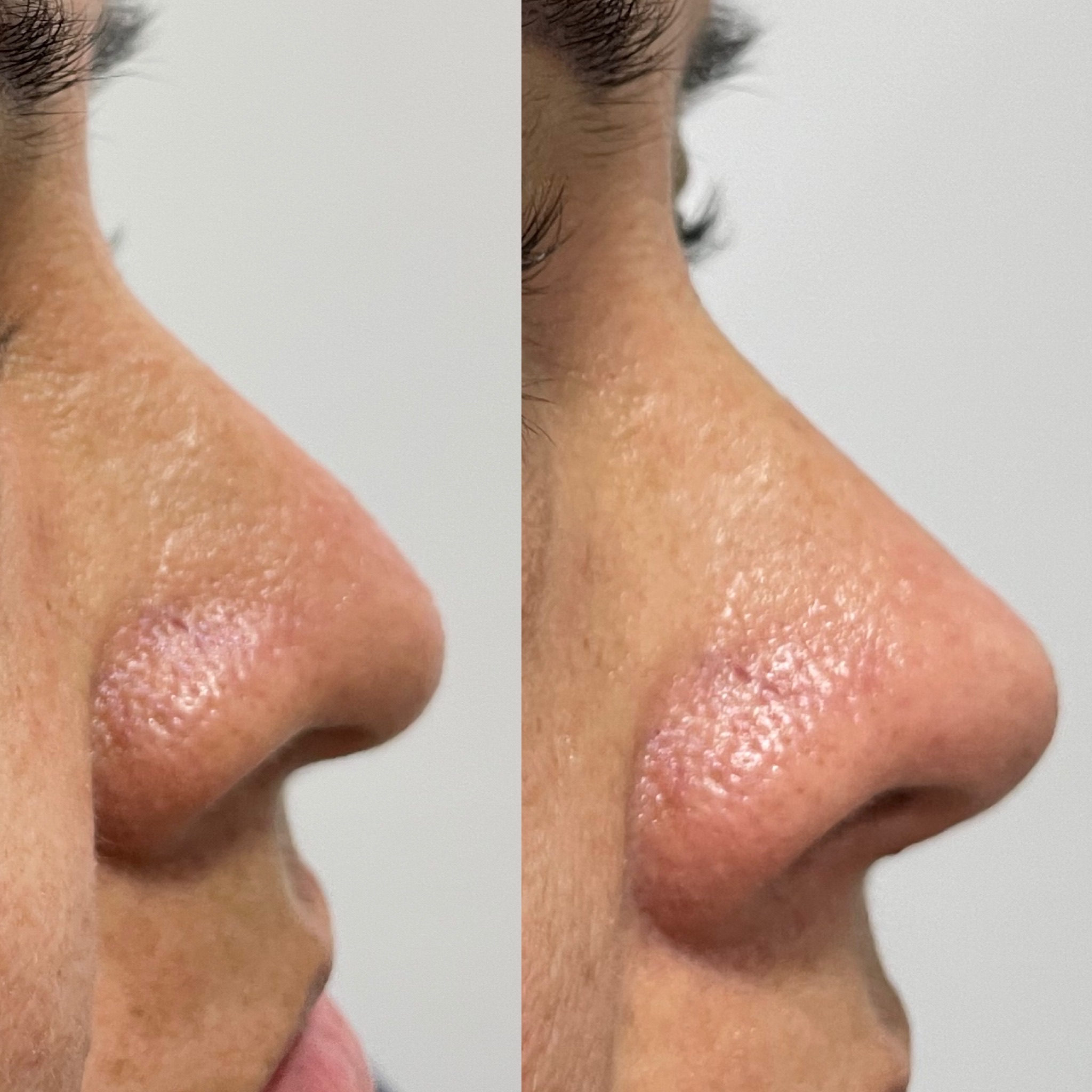 Rinomodelación con Ácido Hialurónico